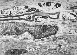 M,3y. | globoid leukodystrophy of Krabbe - n.suralis